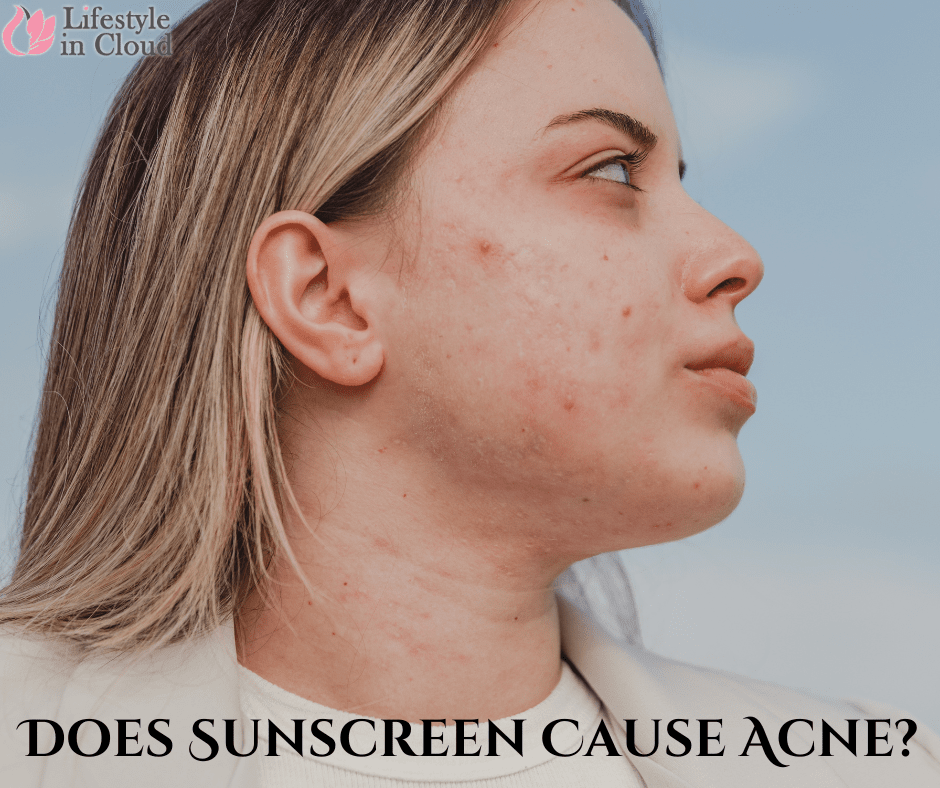 Does Sunscreen Cause Acne?