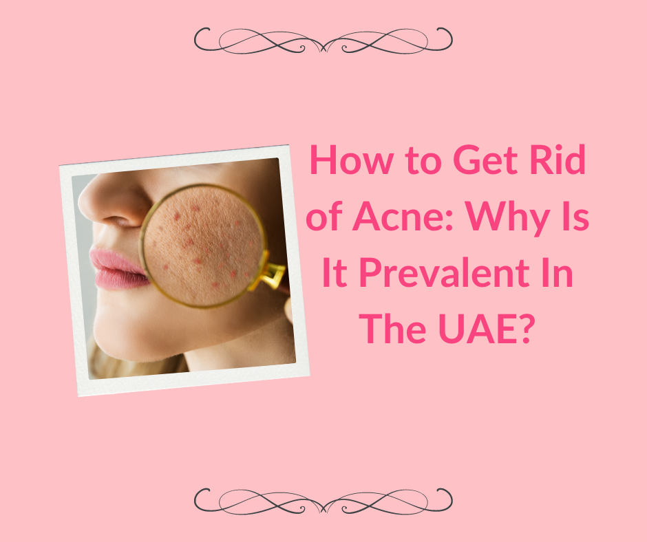 How to Get Rid of Acne Why Is It Prevalent In The UAE